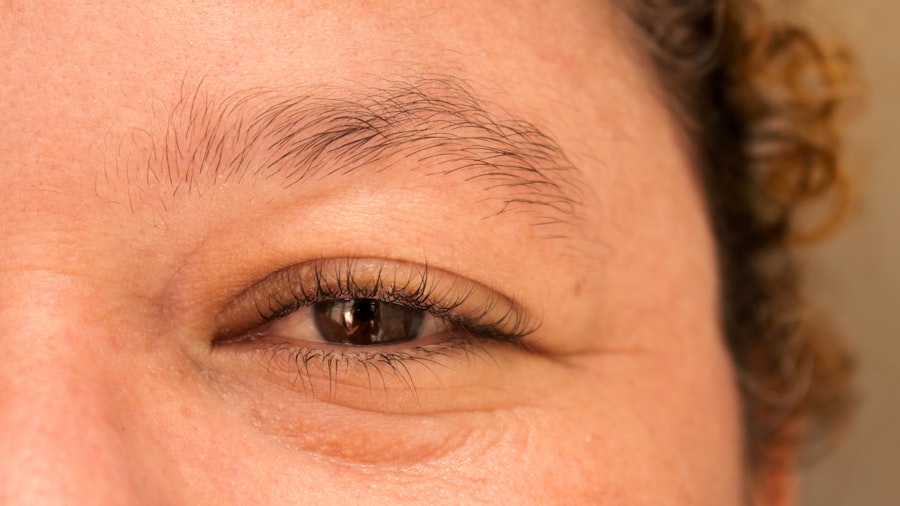 double eyelid surgery