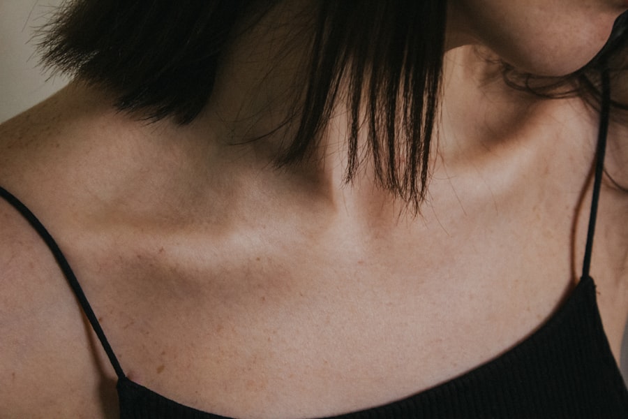 stretch marks