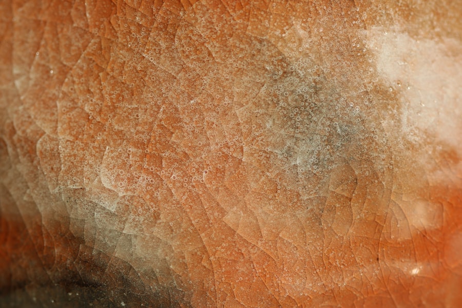 acne scars