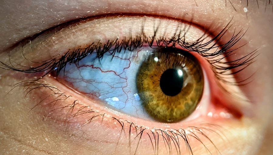 eyelid surgery