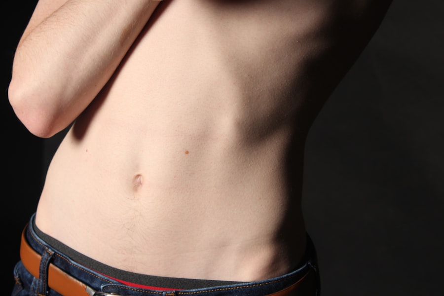 Photo liposuction