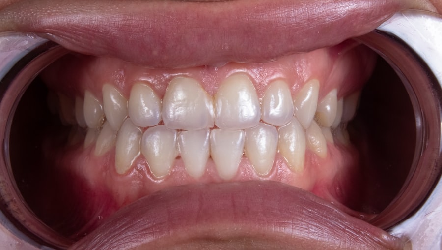 Photo teeth whitening