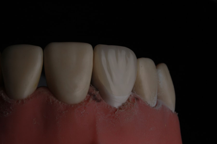 Photo tooth restoration