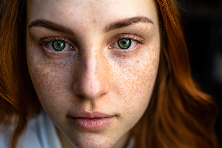 Photo acne scars