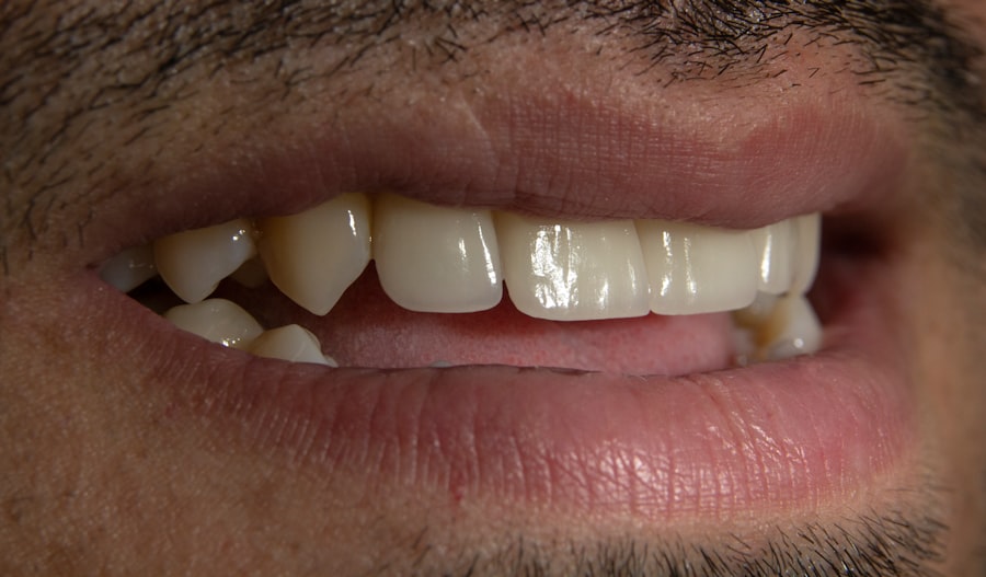 Photo teeth whitening price