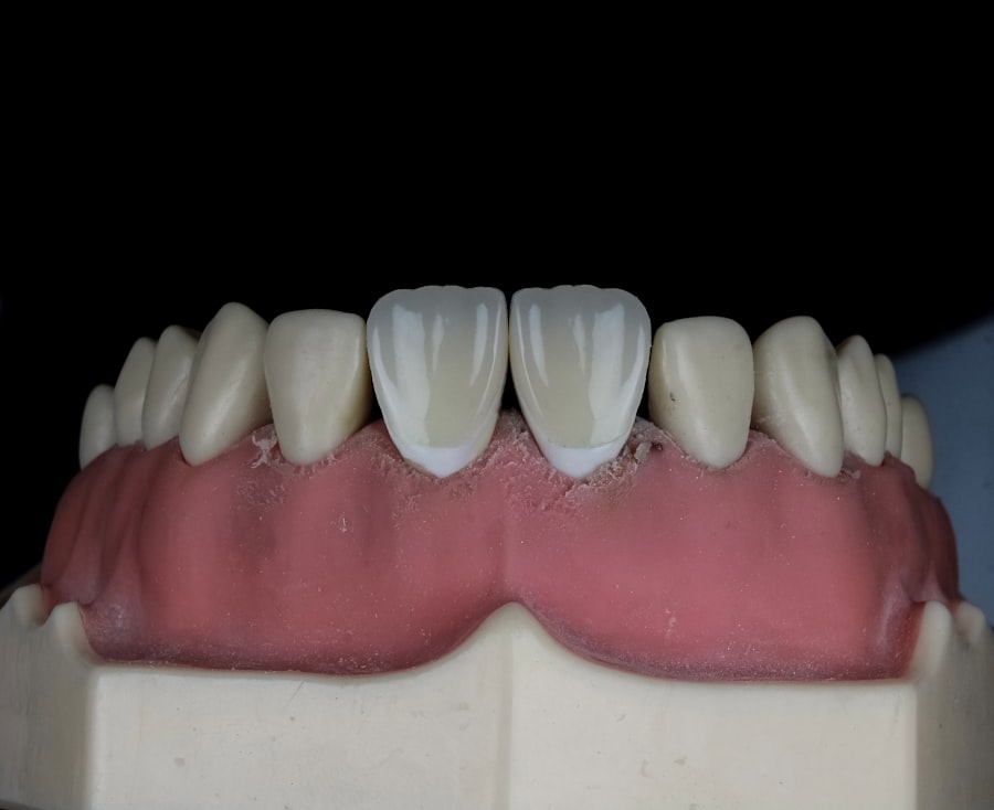 Gum contouring