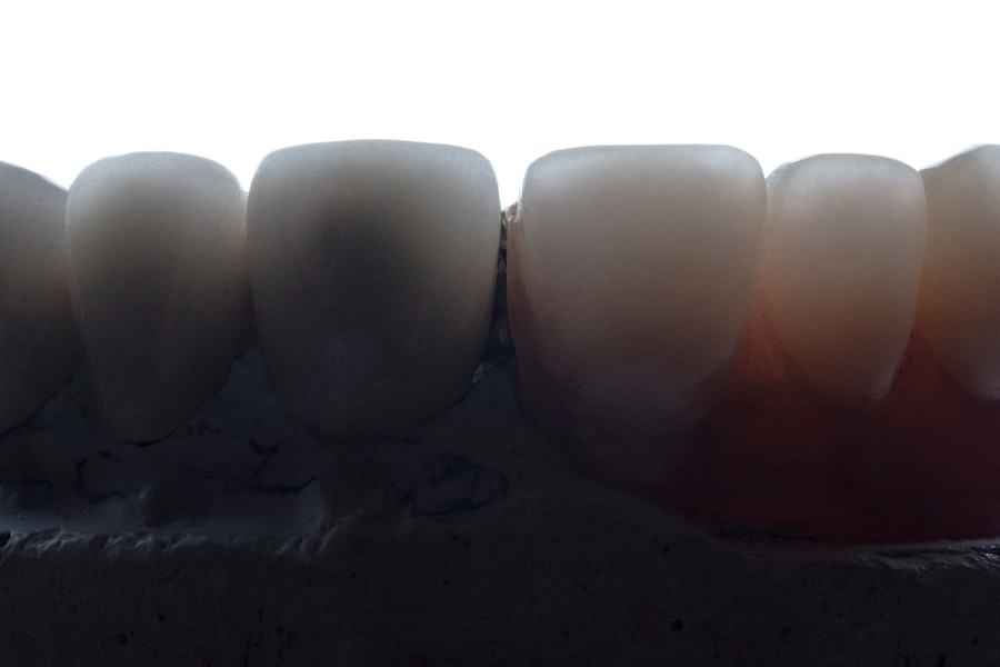 dental veneers