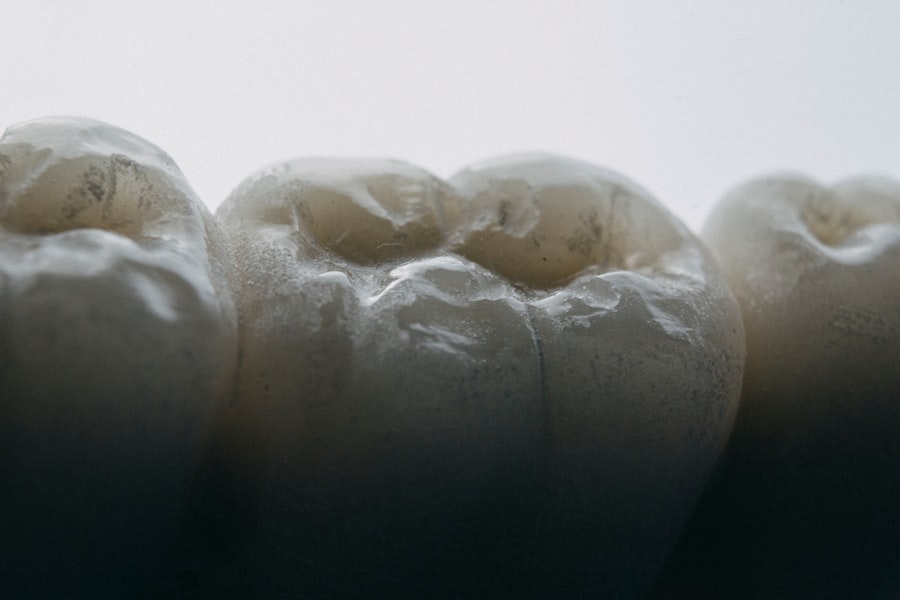 Photo dental veneers
