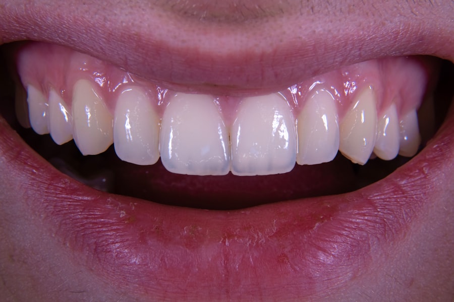 Photo teeth whitening price