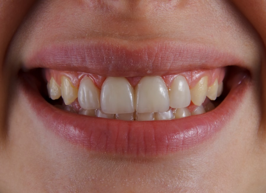 teeth whitening strips