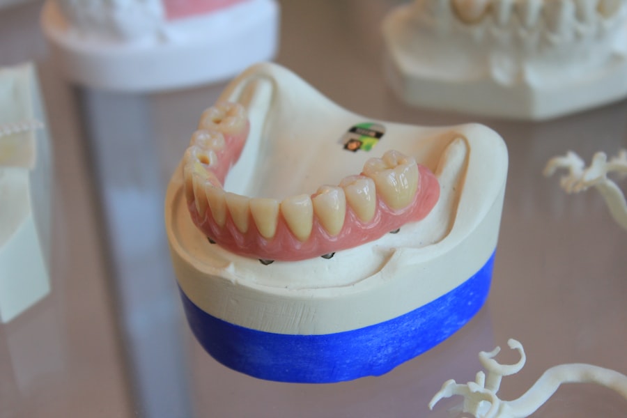 Photo dental veneers