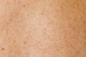 Read more about the article 如何讓臉上的坑洞不見？凹疤重建療程真實分享